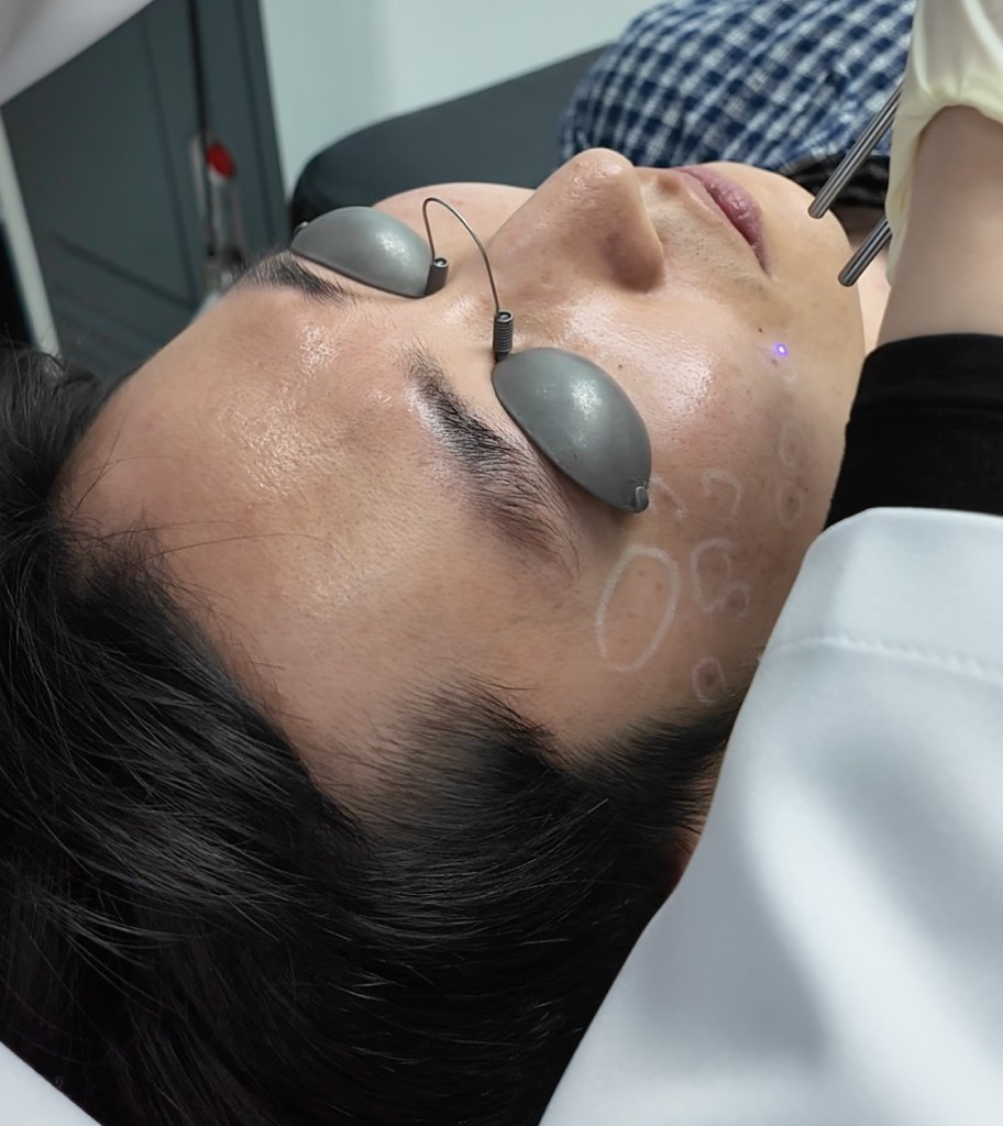 Pico laser treatment with protective eye shields at Tune Clinic