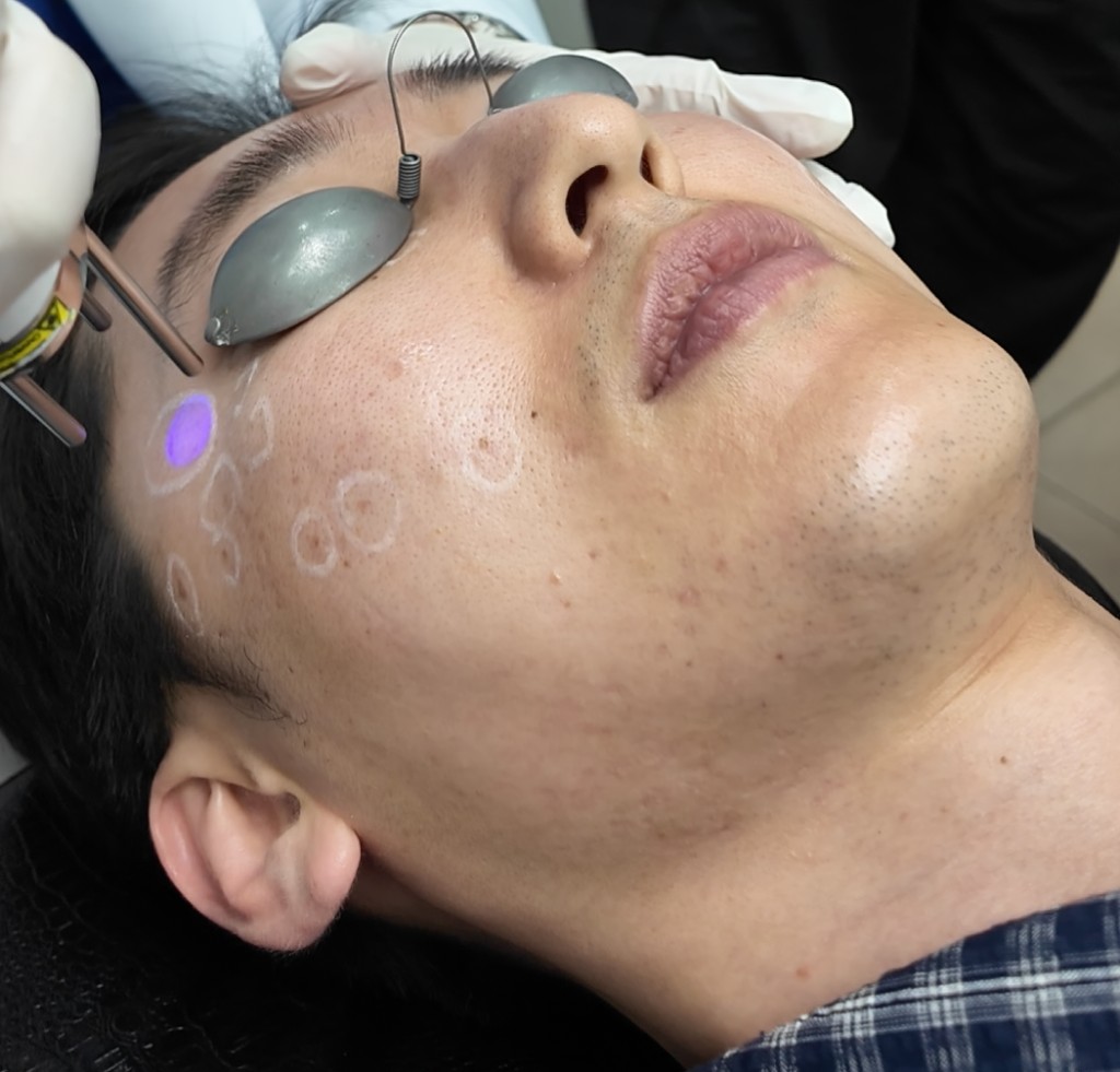 Laser treatment guided by mapped treatment zones