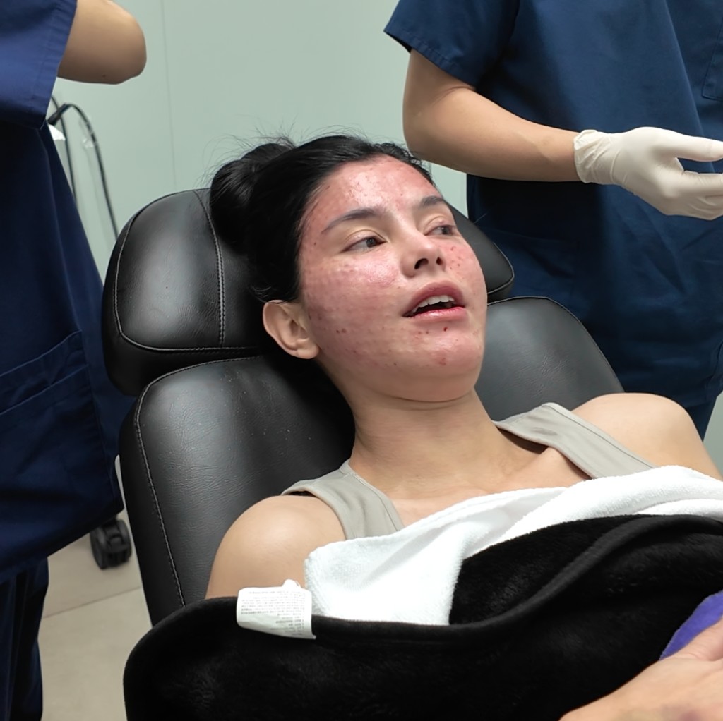 An international patient prepared for an acne treatment session