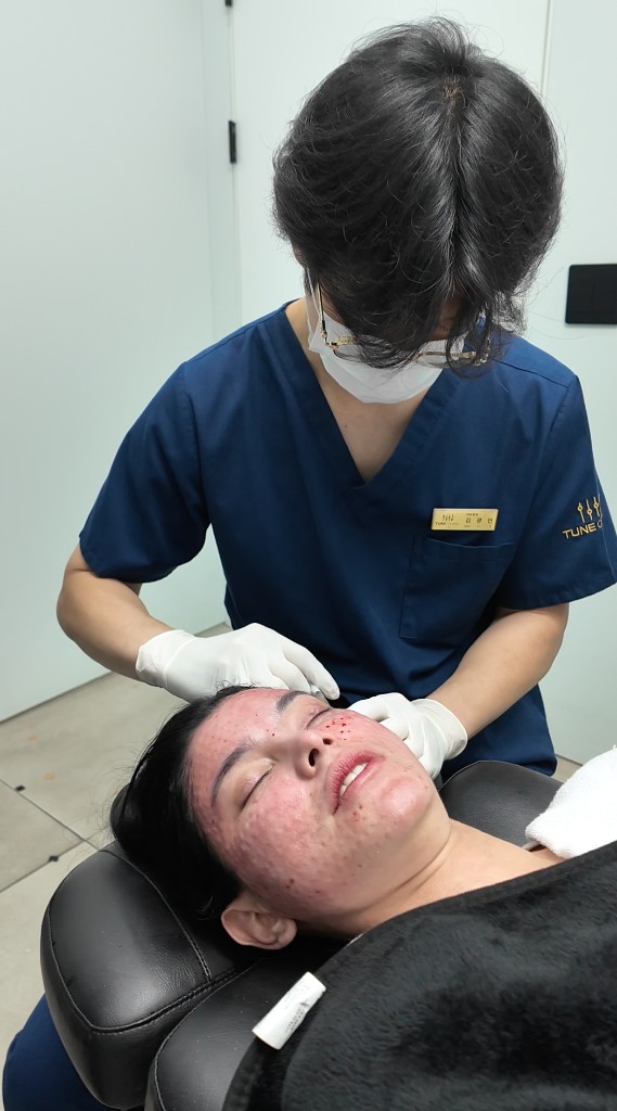 Clinician treating a patient's acne-prone skin