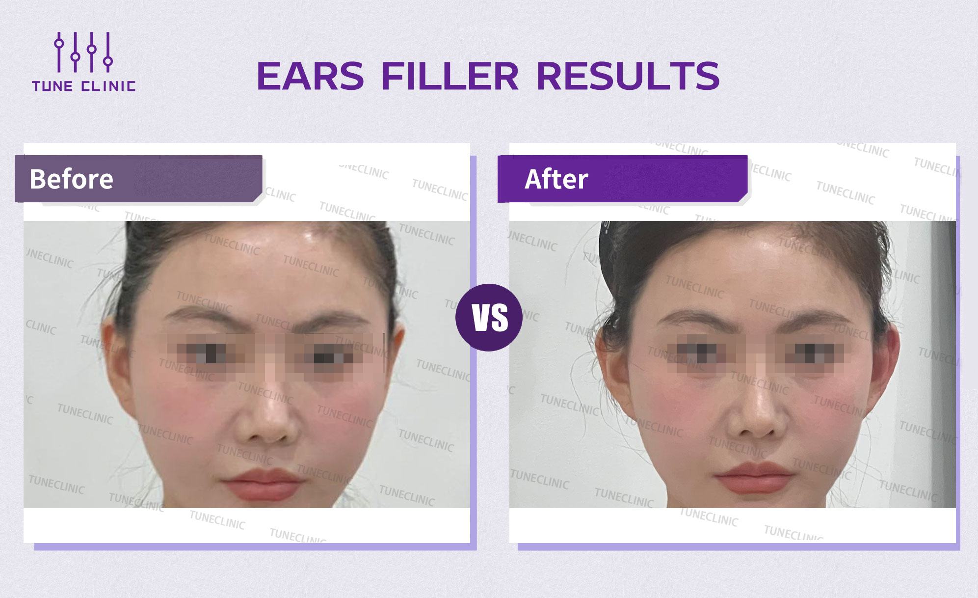 Before and after — Ear Lobe Filler