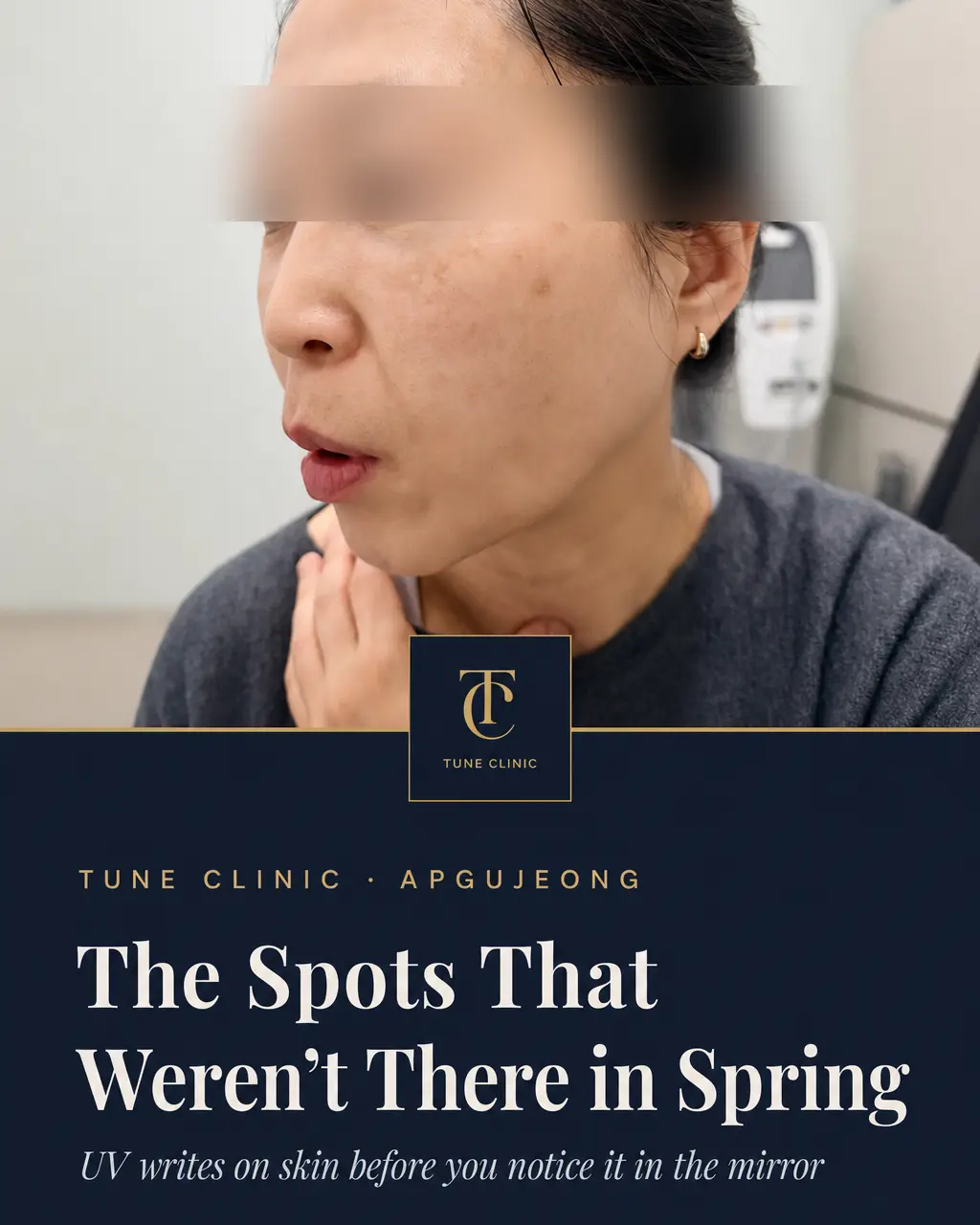 The Spots That Weren't There in Spring — UV writes on skin before you notice it in the mirror