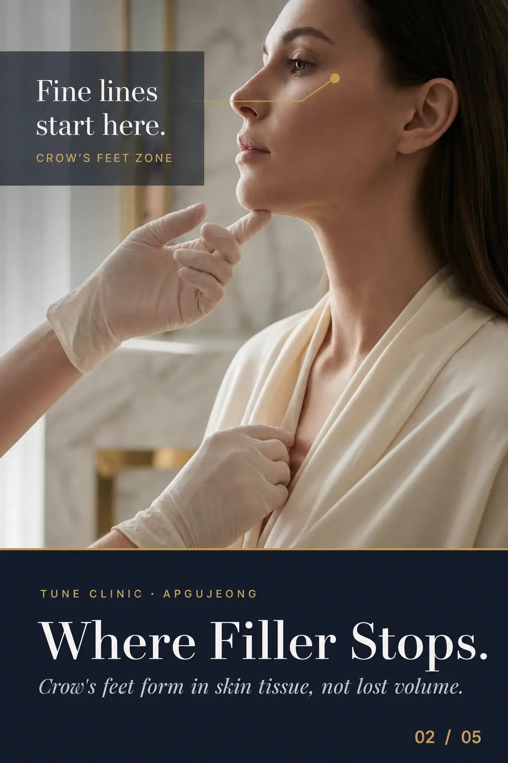 Where Filler Stops. — Crow's feet form in skin tissue, not lost volume.