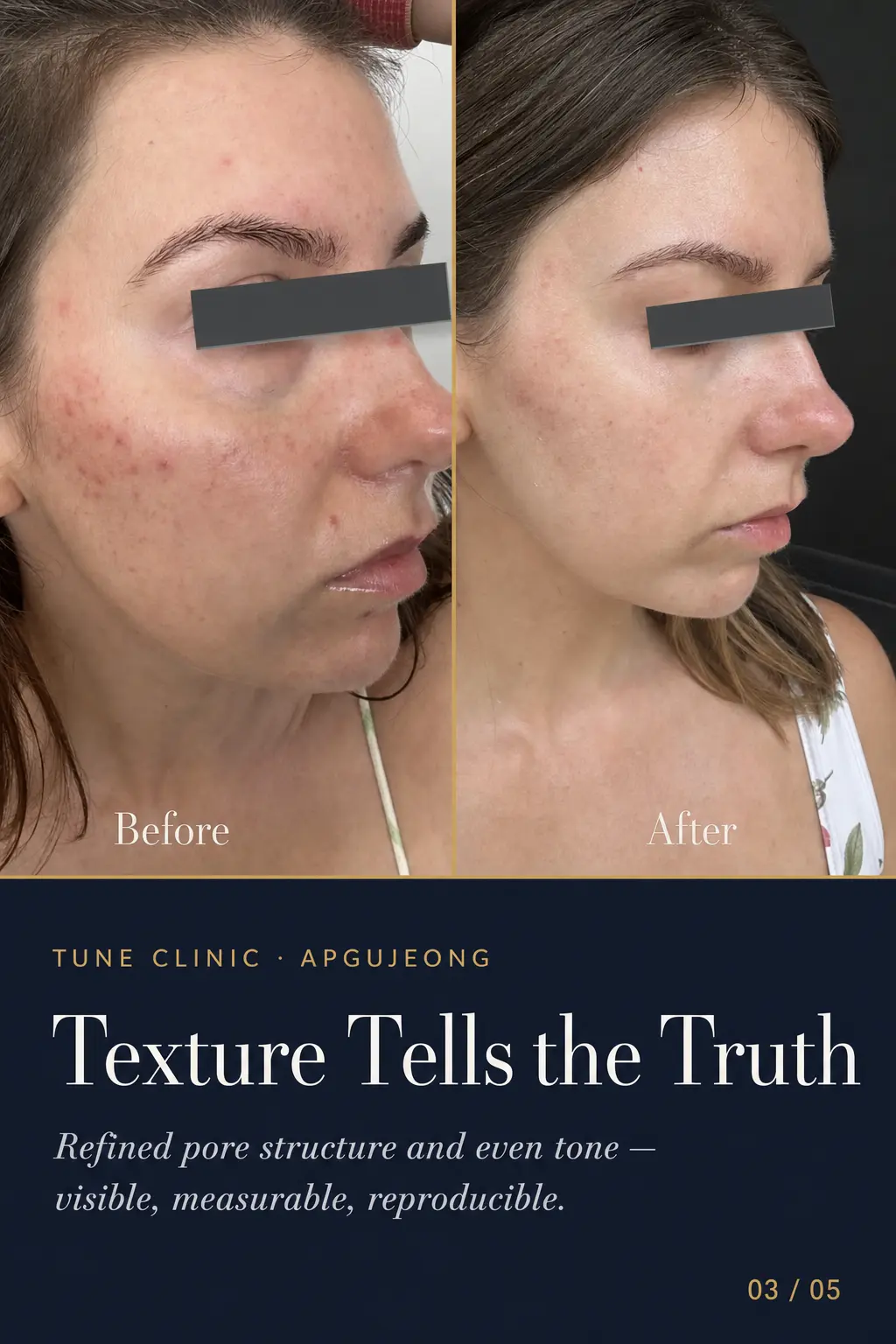 Texture Tells the Truth — Refined pore structure and even tone — visible, measurable, reproducible.