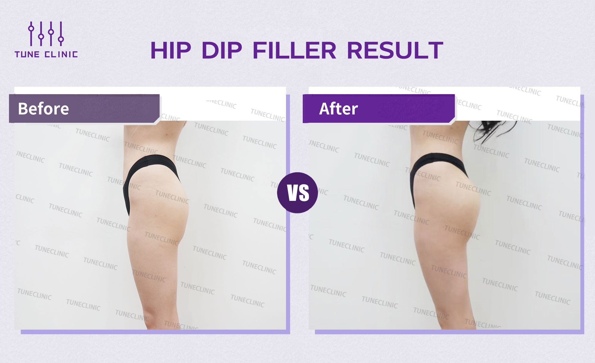 Before and after — Hip Dip Correction