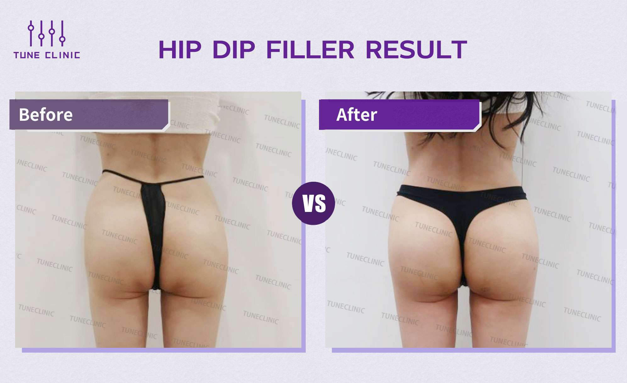 Before and after — Hip Dip Correction