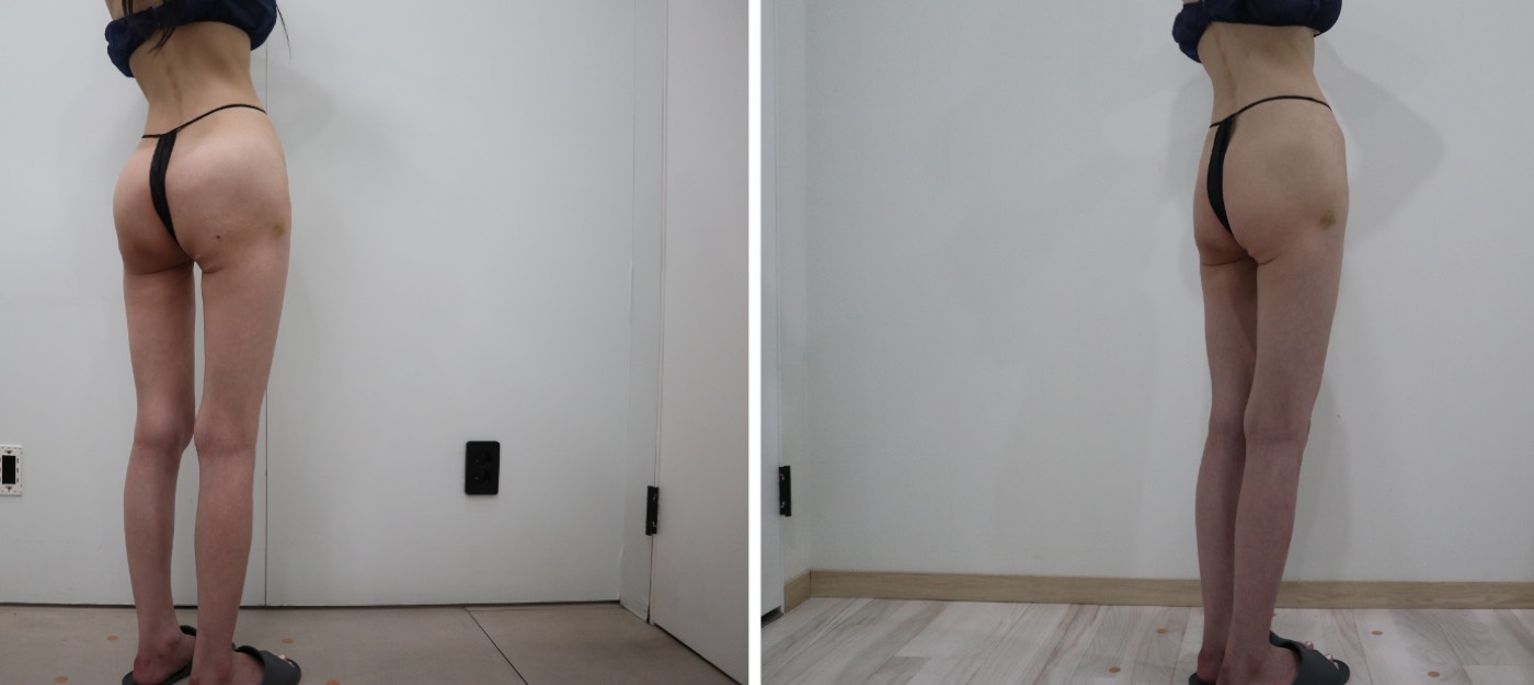Before and after — Hip & Buttock Filler