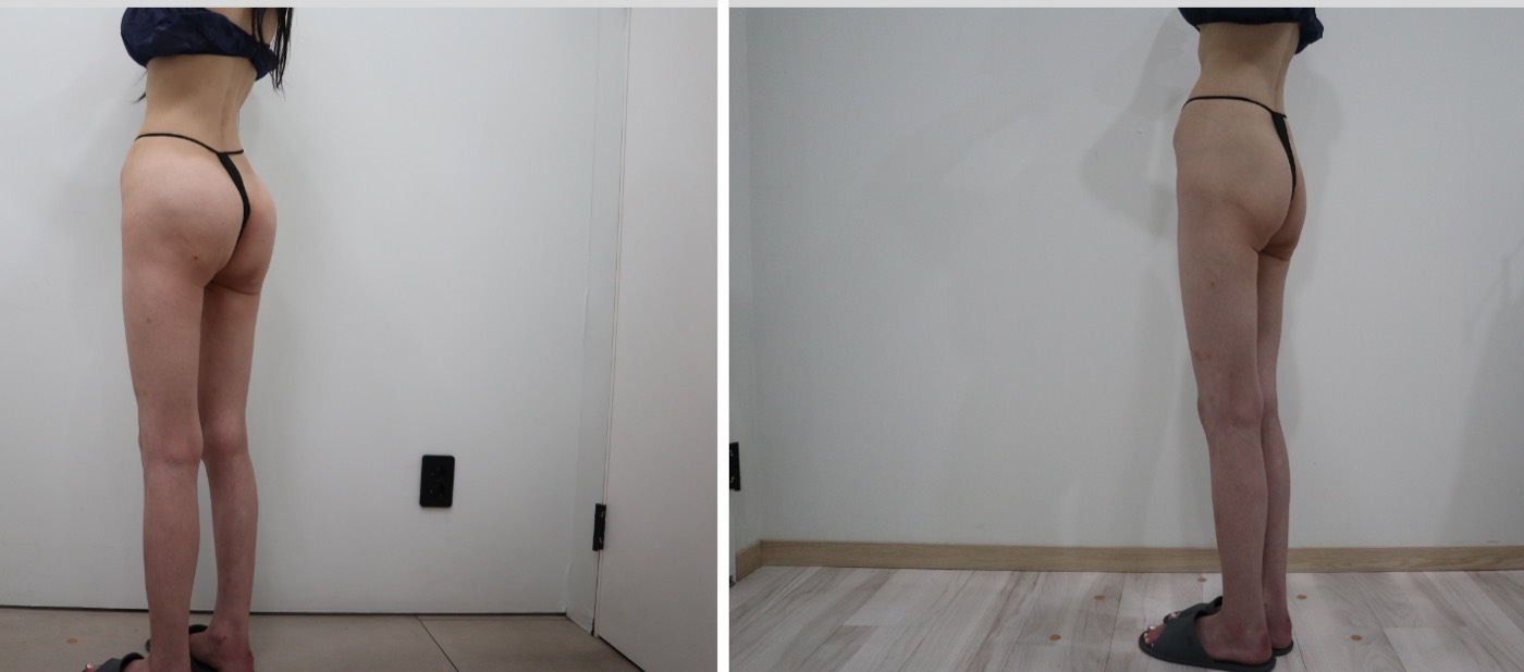 Before and after — Hip & Buttock Filler