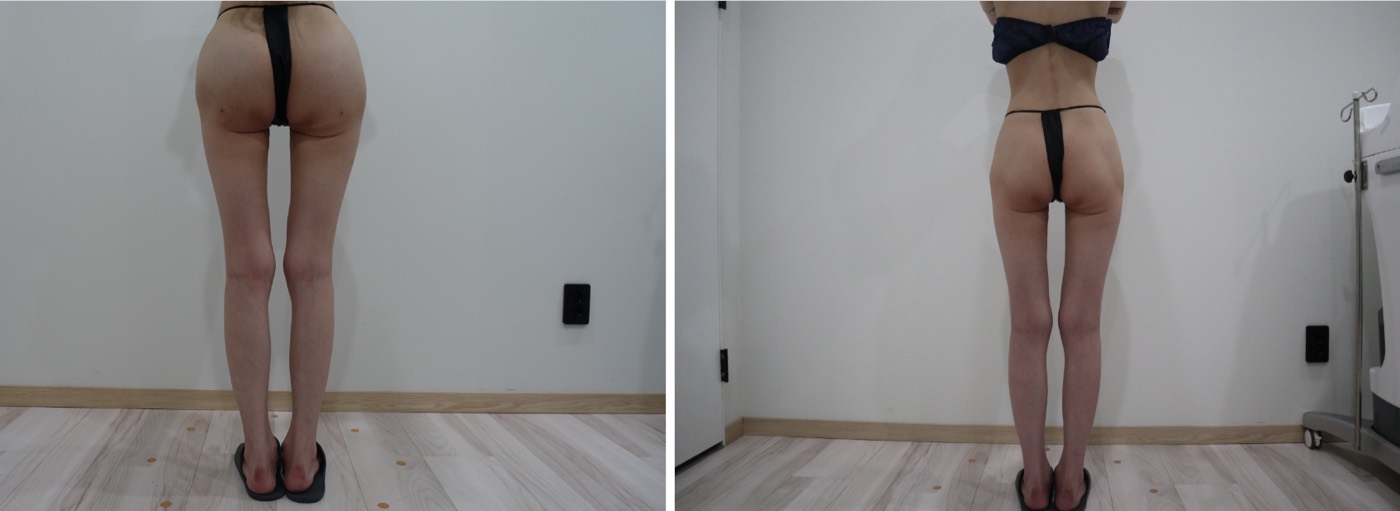 Before and after — Hip & Buttock Filler