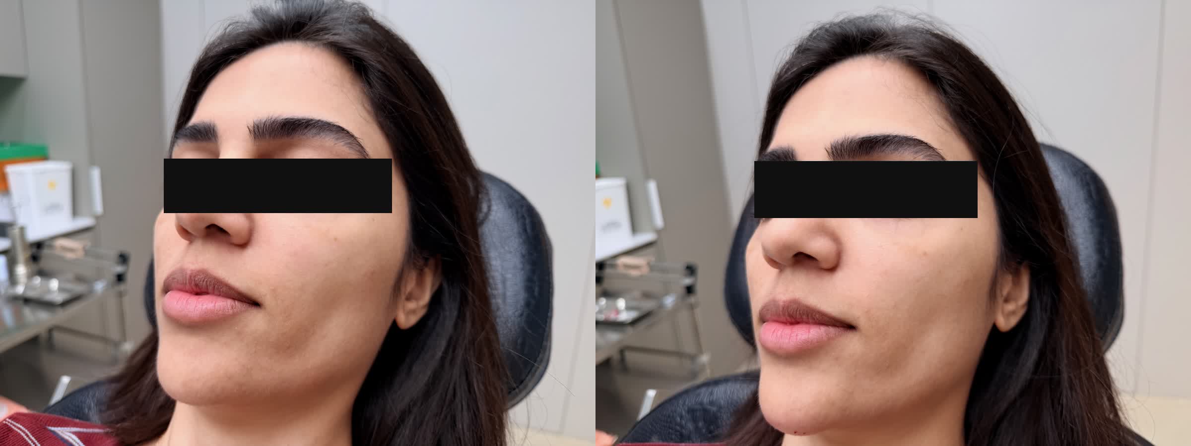Before and After - Chin Filler, Left Profile
