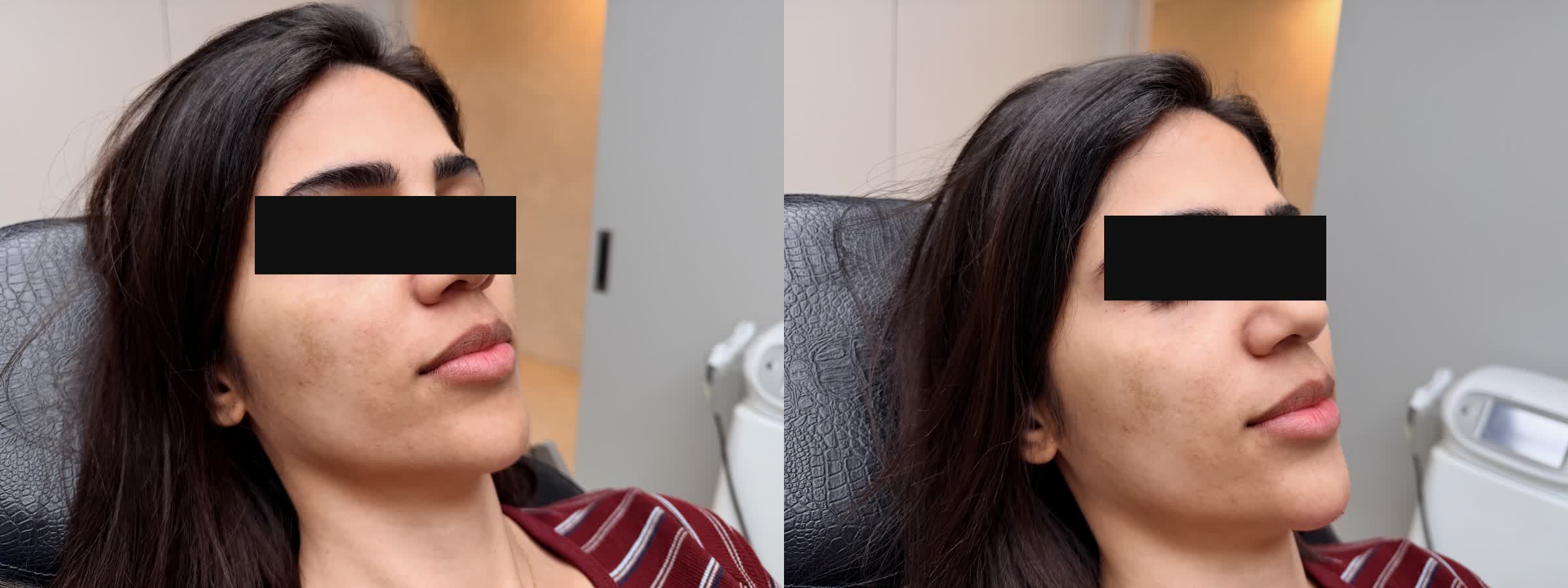 Before and After - Chin Filler, Right Profile