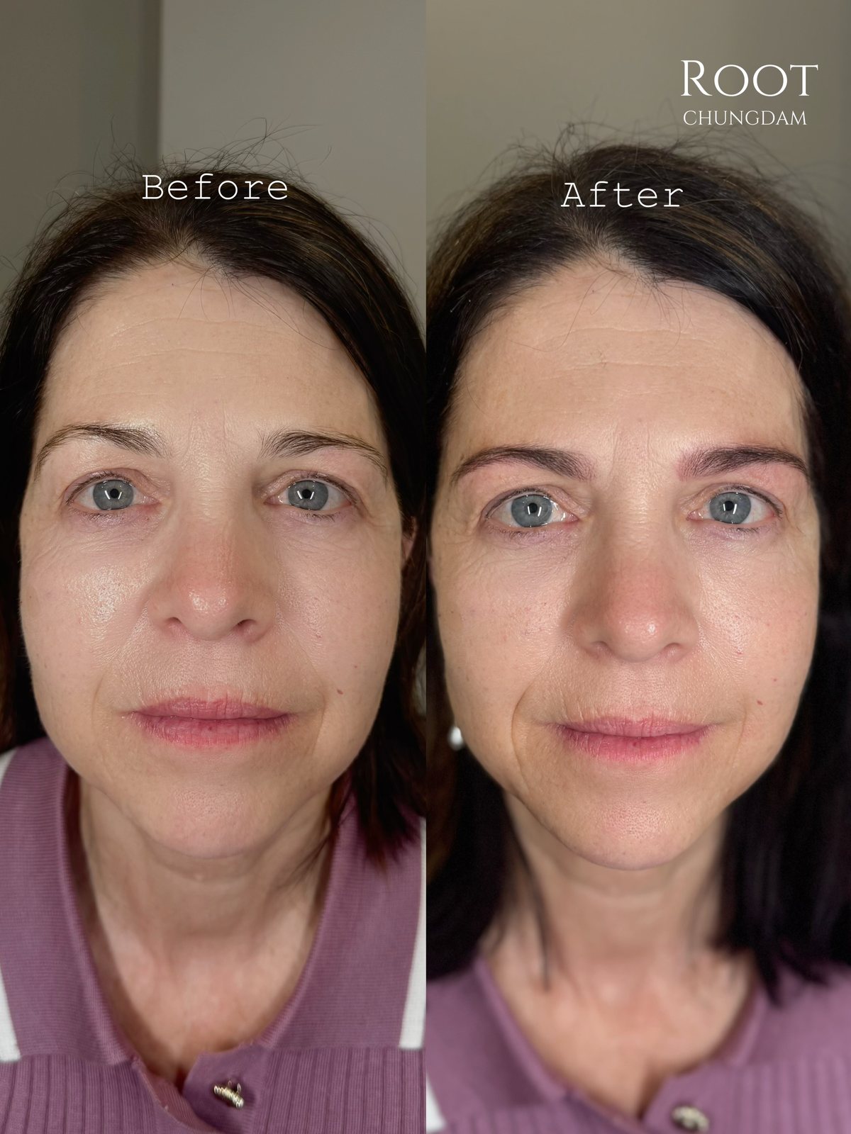 Root Chungdam hair-stroke brow portfolio composite, case 13