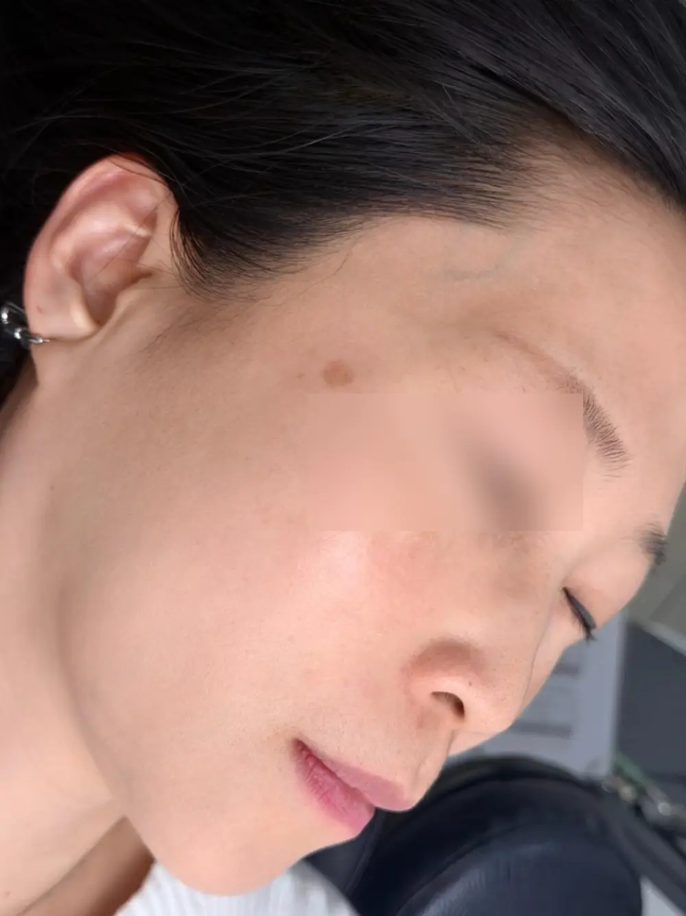 Pico laser treatment at Tune Clinic — 4