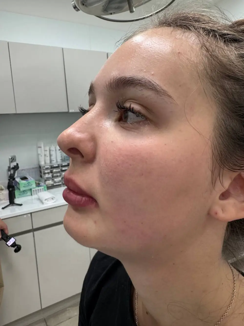 Lip filler treatment at Tune Clinic — 3