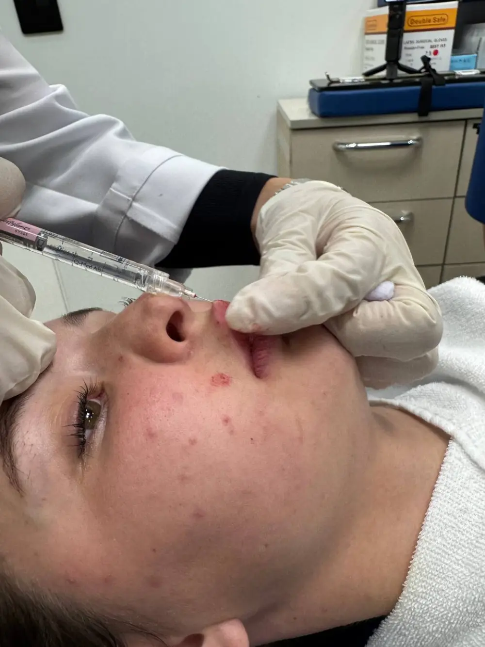 Lip filler treatment at Tune Clinic — 4