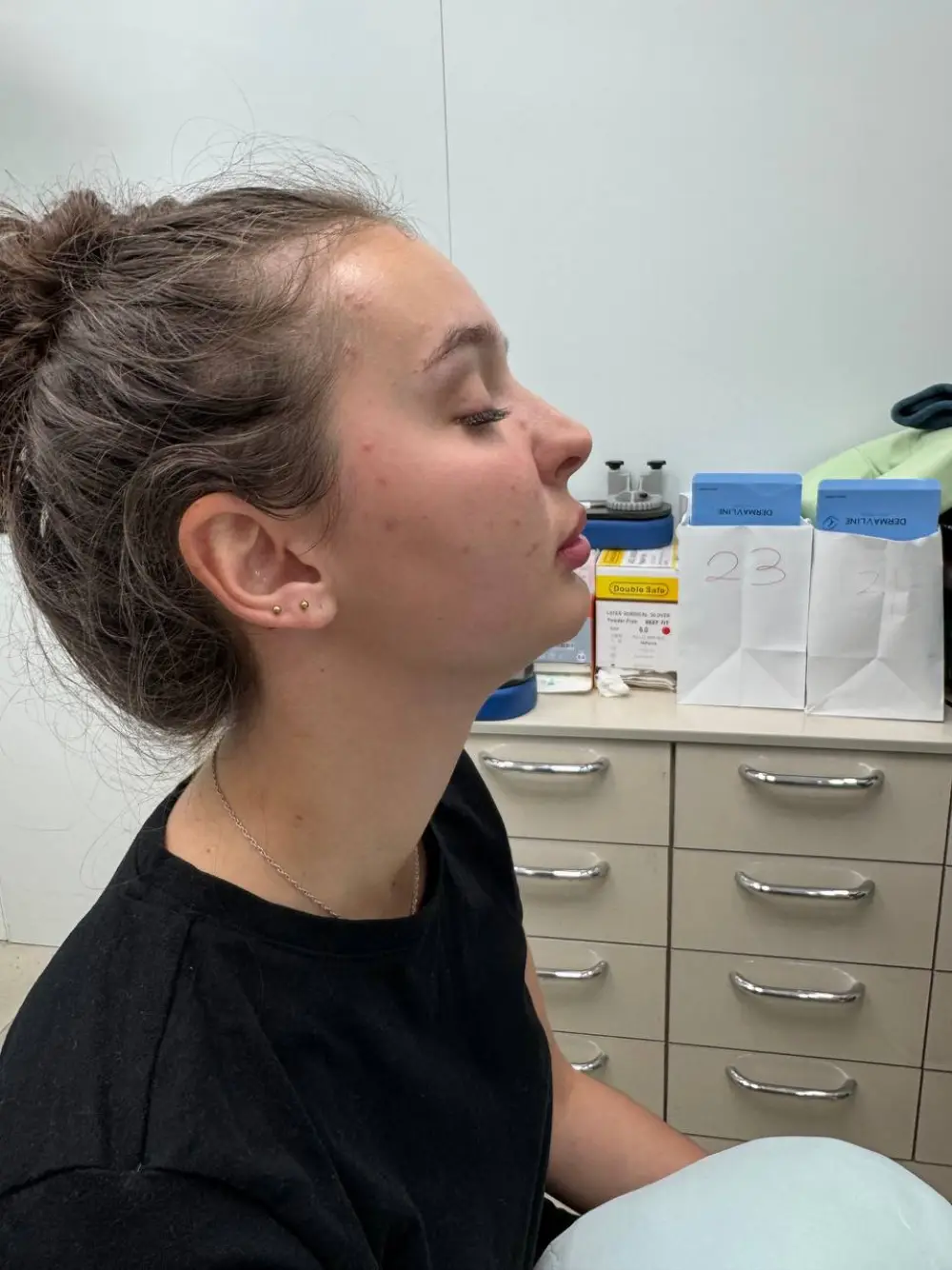 Lip filler treatment at Tune Clinic — 5