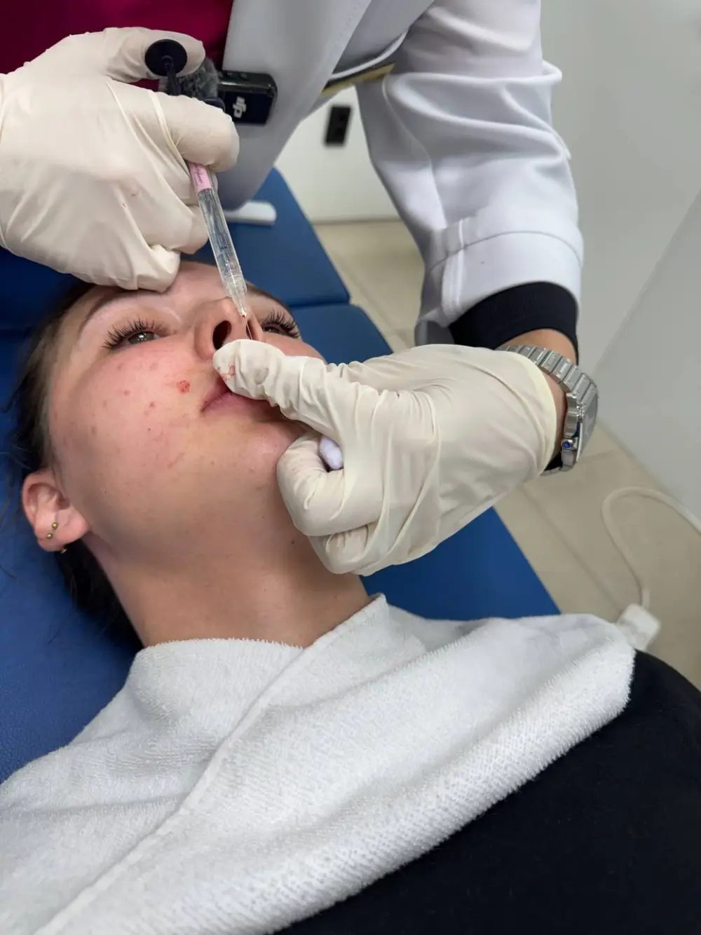 Lip filler treatment at Tune Clinic — 6