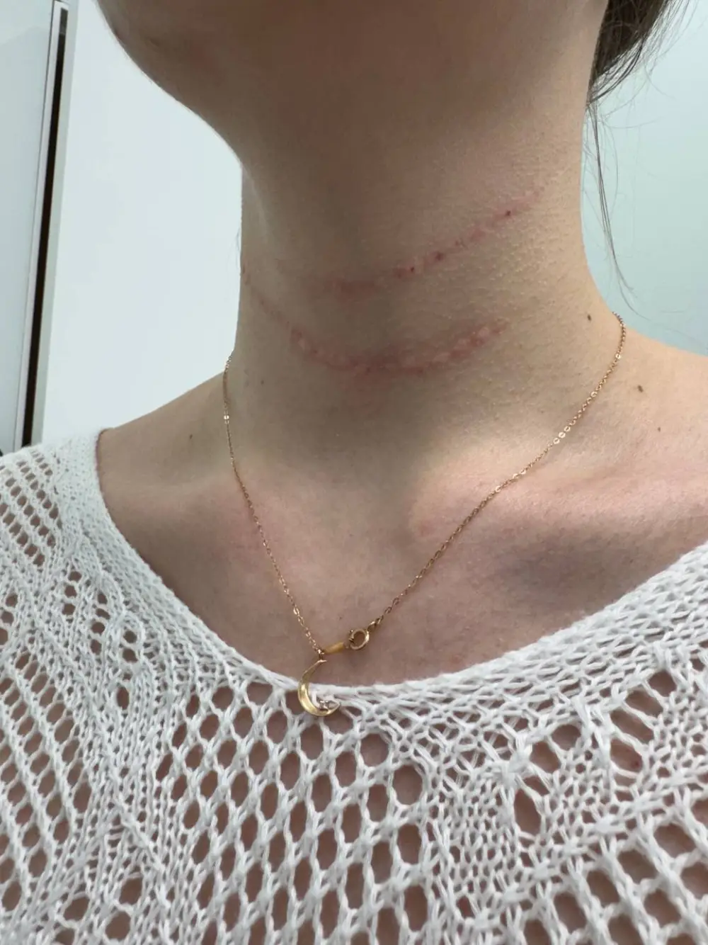 Neck wrinkle filler at Tune Clinic — 2