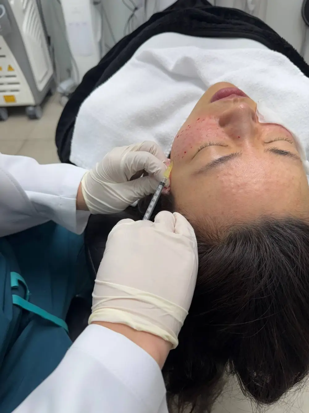 Collagen-stimulator (PLLA) treatment at Tune Clinic — 5