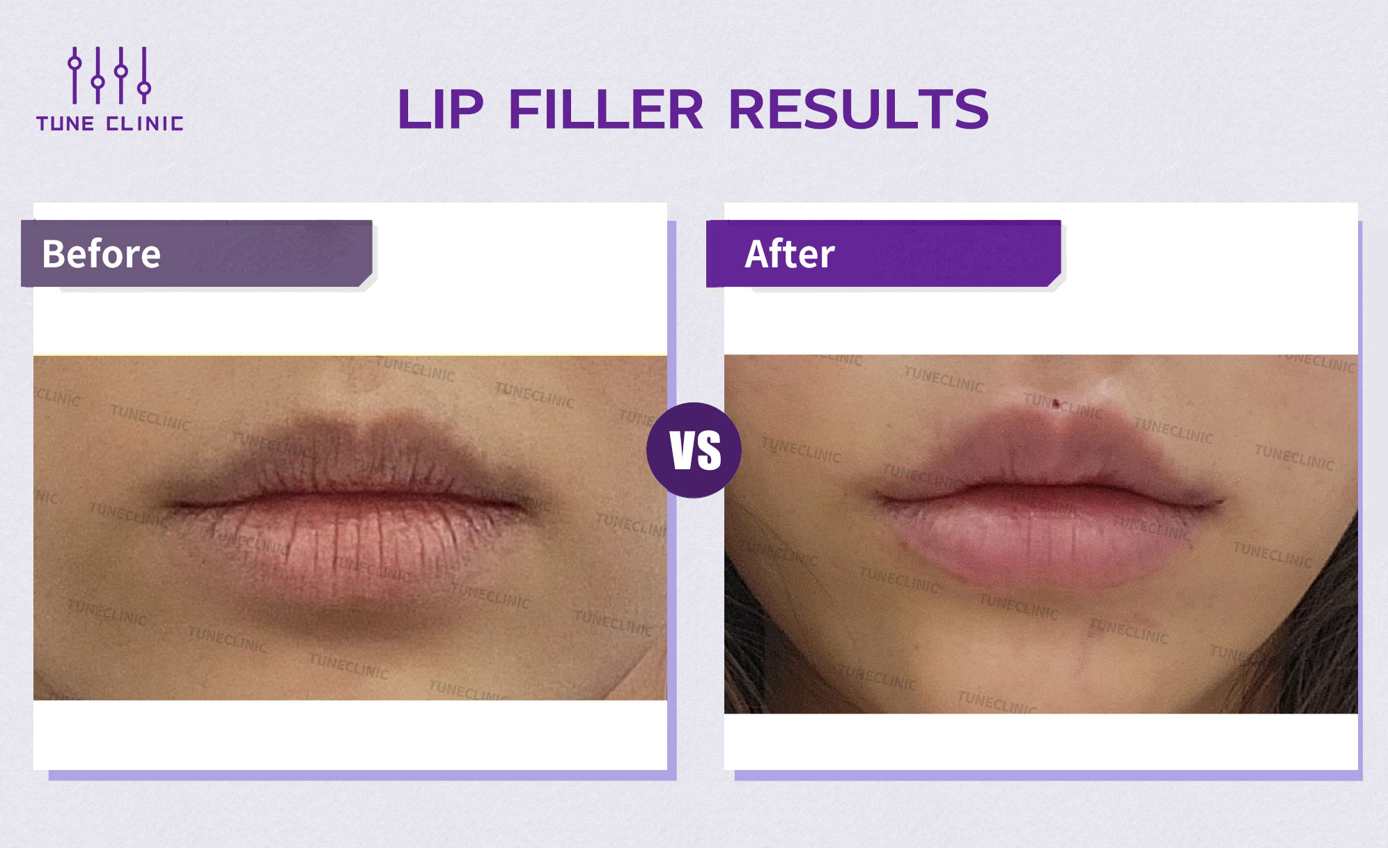 Before and after — Lip Filler