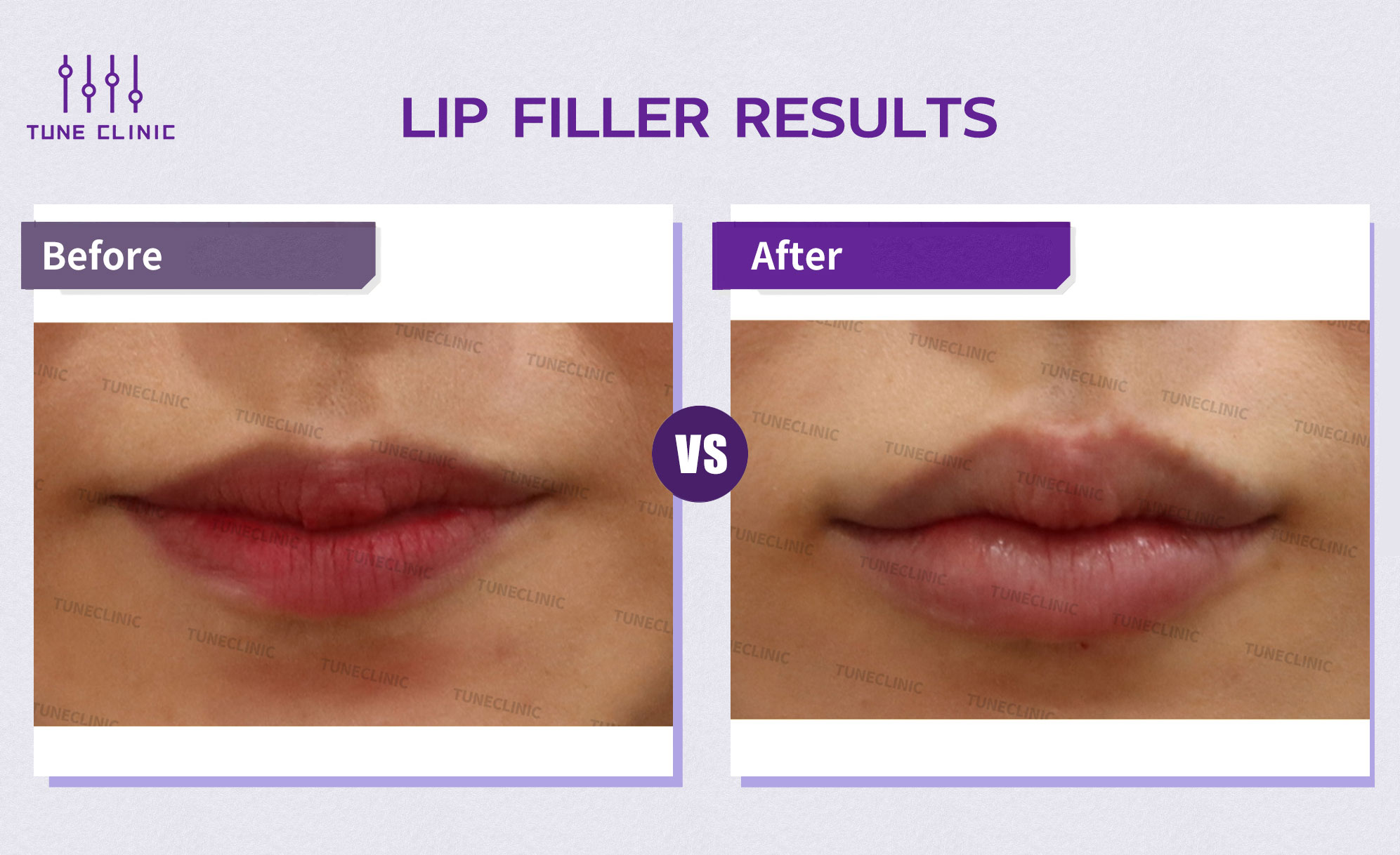 Before and after — Lip Filler