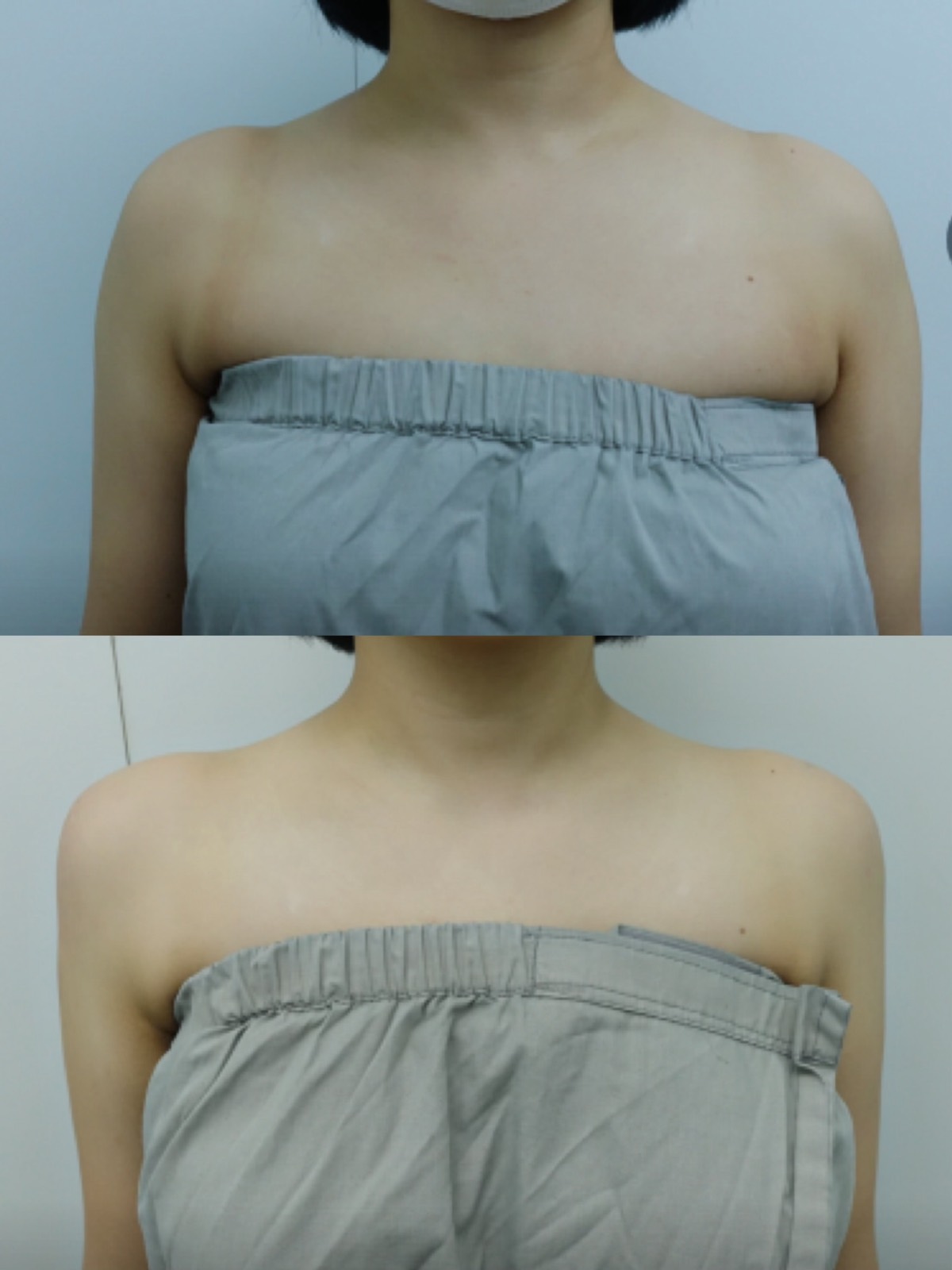 Before and after — Shoulder Line Filler