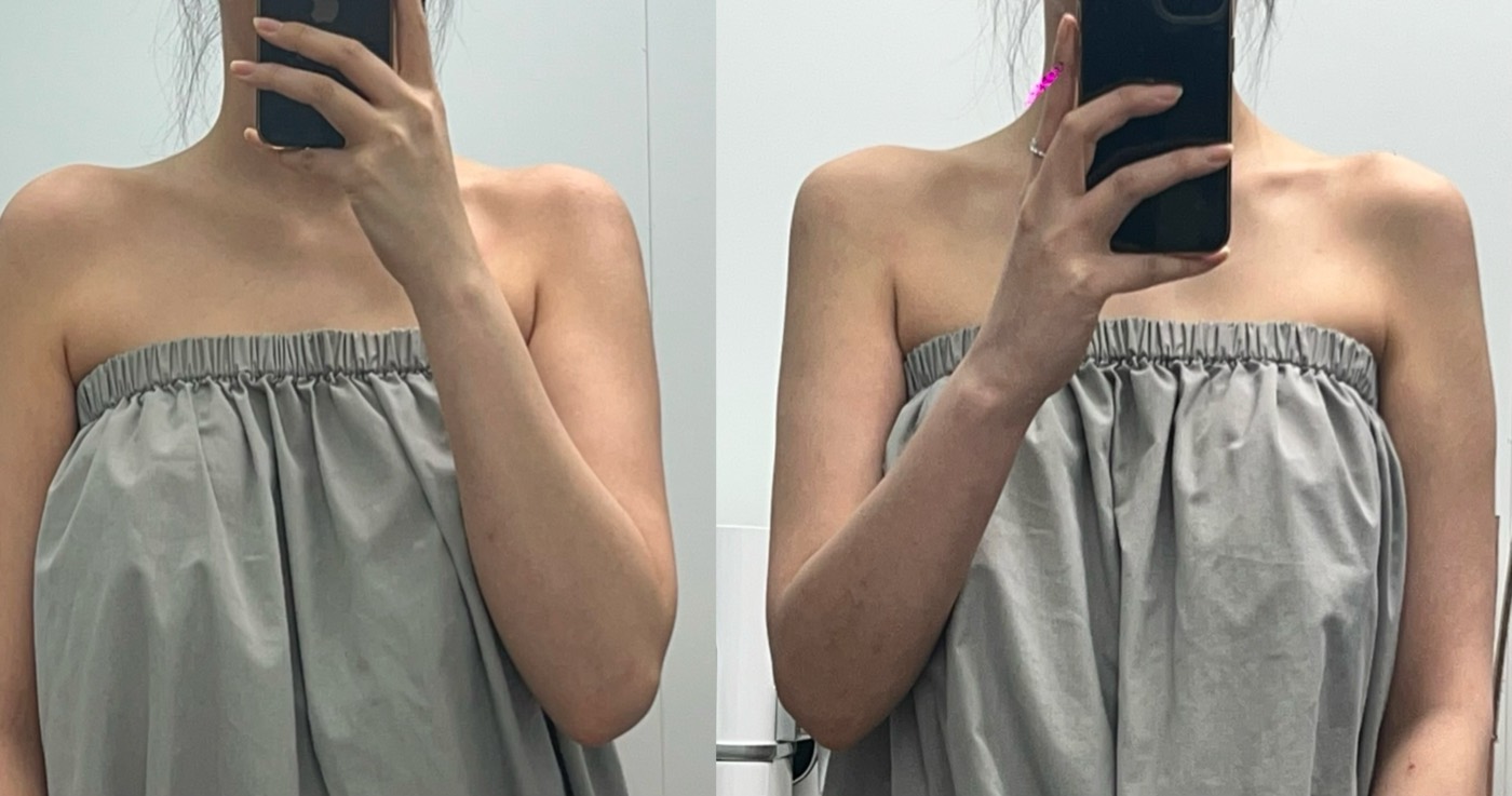 Before and after — Shoulder Line Filler