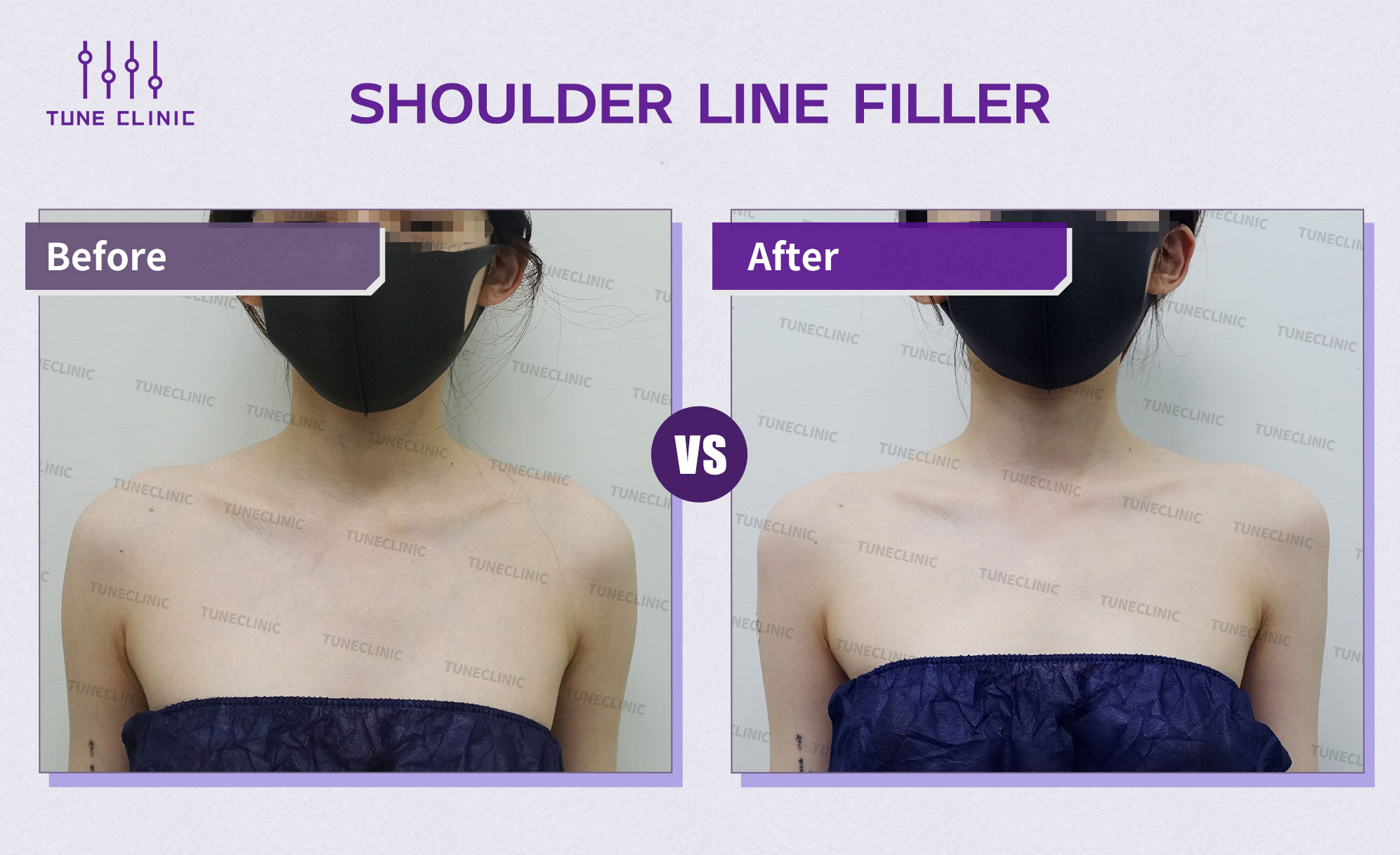 Before and after — Shoulder Line Filler