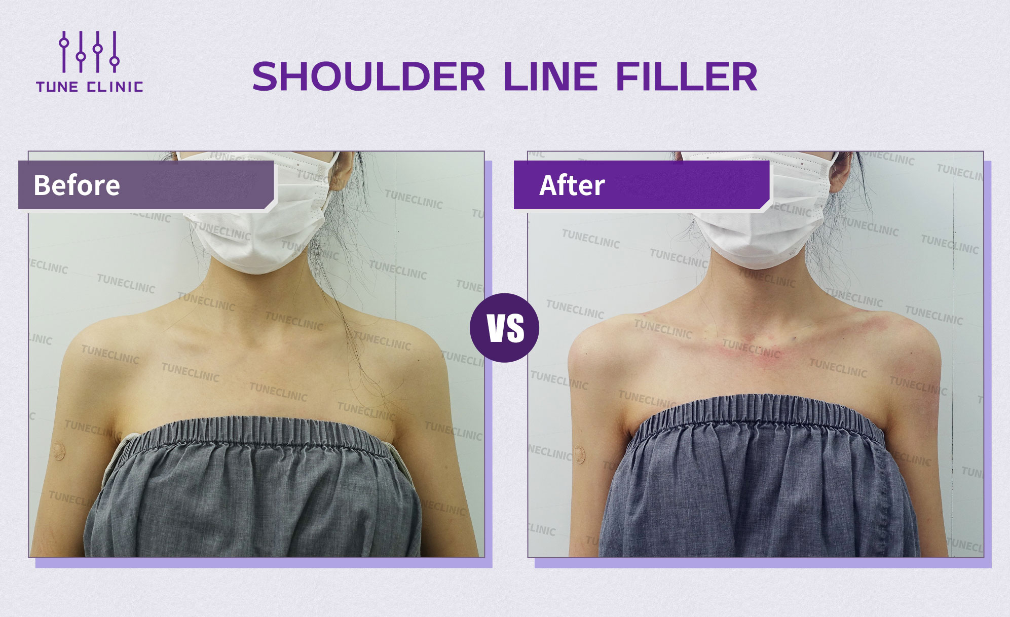 Before and after — Shoulder Line Filler