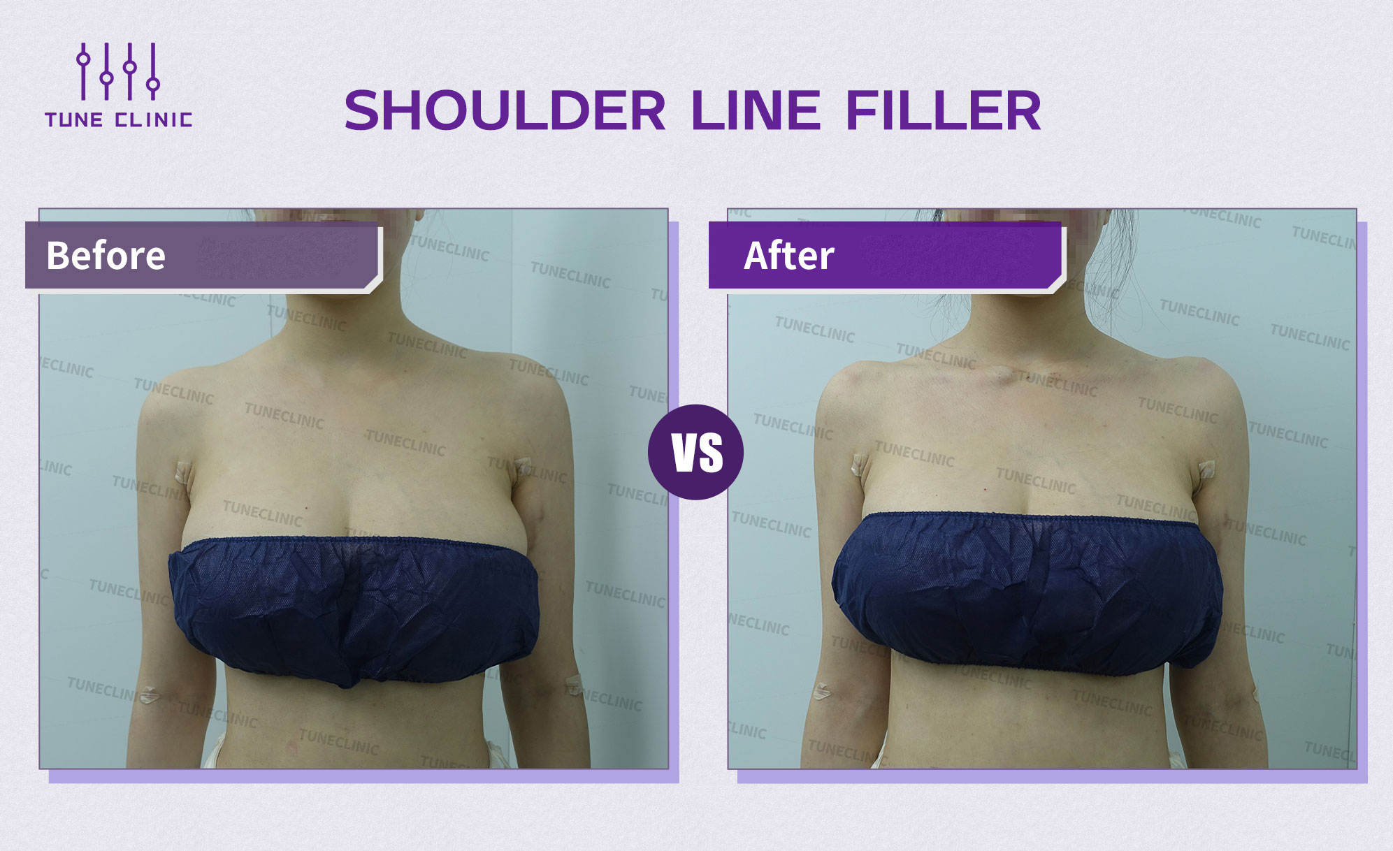 Before and after — Shoulder Line Filler